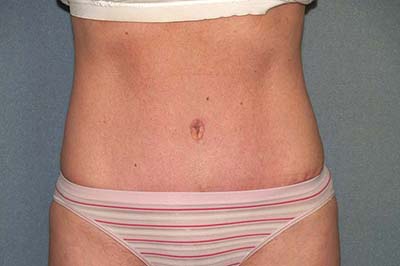 Tummy Tuck Before & After Patient #5704