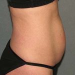 Tummy Tuck Before & After Patient #5704