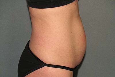 Tummy Tuck Before & After Patient #5704