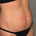 Tummy Tuck Before & After Patient #5704