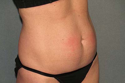 Tummy Tuck Before & After Patient #5704