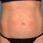 Tummy Tuck Before & After Patient #5704