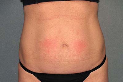 Tummy Tuck Before & After Patient #5704