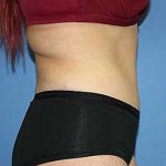 Tummy Tuck Before & After Patient #5737
