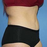 Tummy Tuck Before & After Patient #5737