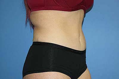 Tummy Tuck Before & After Patient #5737