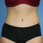 Tummy Tuck Before & After Patient #5737