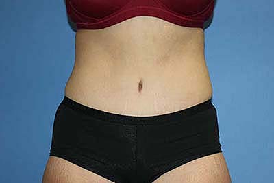 Tummy Tuck Before & After Patient #5737