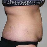 Tummy Tuck Before & After Patient #5737