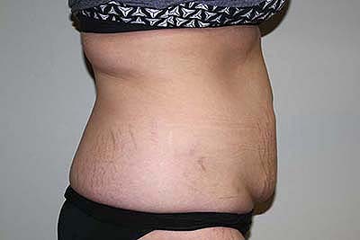 Tummy Tuck Before & After Patient #5737