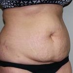 Tummy Tuck Before & After Patient #5737