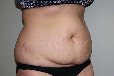 Tummy Tuck Before & After Patient #5737