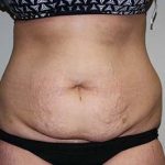 Tummy Tuck Before & After Patient #5737