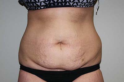 Tummy Tuck Before & After Patient #5737