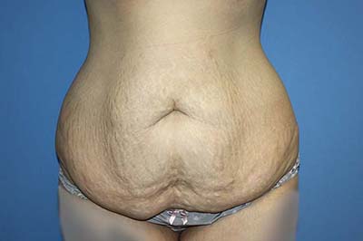 Tummy Tuck Before & After Patient #5730