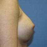 Breast Augmentation Before & After Patient #5732