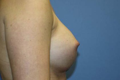 Breast Augmentation Before & After Patient #5732