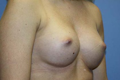 Breast Augmentation Before & After Patient #5732