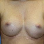 Breast Augmentation Before & After Patient #5732