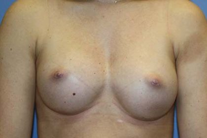 Breast Augmentation Before & After Patient #5732