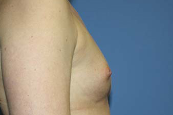 Breast Augmentation Before & After Patient #5732