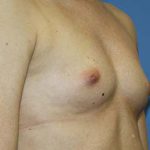 Breast Augmentation Before & After Patient #5732