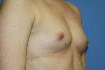 Breast Augmentation Before & After Patient #5732