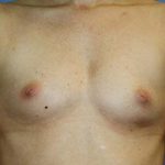 Breast Augmentation Before & After Patient #5732