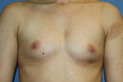 Breast Augmentation Before & After Patient #5732