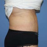 Tummy Tuck Before & After Patient #5745