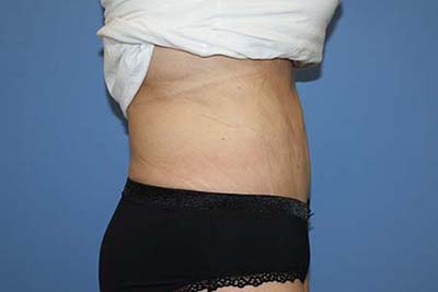 Tummy Tuck Before & After Patient #5745