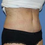 Tummy Tuck Before & After Patient #5745