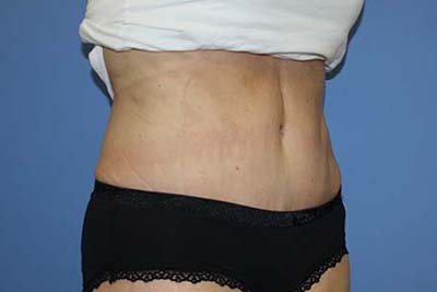 Tummy Tuck Before & After Patient #5745