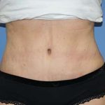 Tummy Tuck Before & After Patient #5745