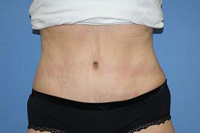 Tummy Tuck Before & After Patient #5745