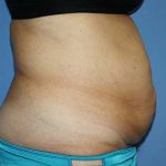 Tummy Tuck Before & After Patient #5745