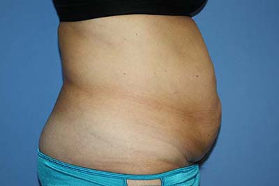 Tummy Tuck Before & After Patient #5745