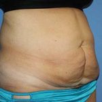 Tummy Tuck Before & After Patient #5745