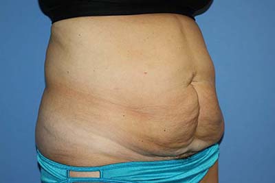 Tummy Tuck Before & After Patient #5745