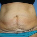 Tummy Tuck Before & After Patient #5745