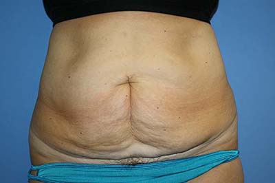 Tummy Tuck Before & After Patient #5745