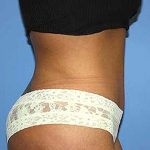Tummy Tuck Before & After Patient #5747