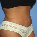 Tummy Tuck Before & After Patient #5747