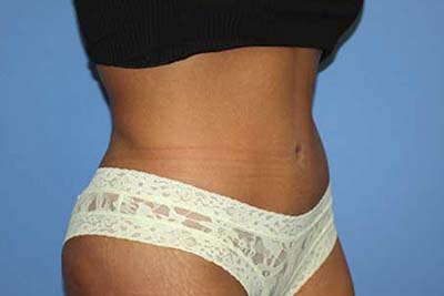 Tummy Tuck Before & After Patient #5747