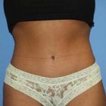 Tummy Tuck Before & After Patient #5747