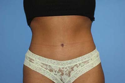 Tummy Tuck Before & After Patient #5747