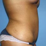 Tummy Tuck Before & After Patient #5747