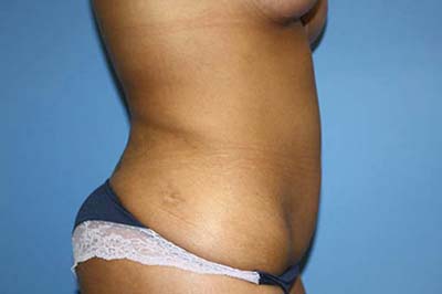 Tummy Tuck Before & After Patient #5747