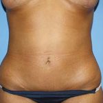 Tummy Tuck Before & After Patient #5747