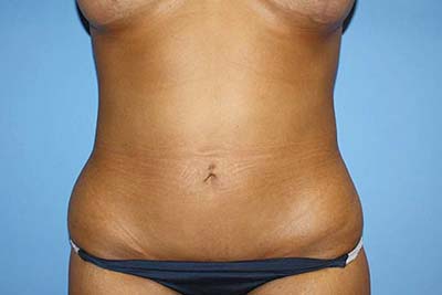 Tummy Tuck Before & After Patient #5747